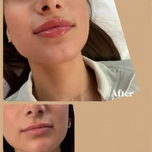 New Lips before/after by Lips Boutique Gallery pp By JKA in Toronto, ON