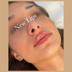 New Lips before/after by Lips Boutique By JKA in Toronto, ON