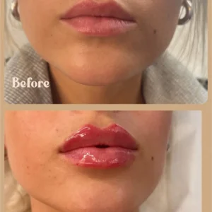 Lip filler before/after by Lips Boutique By JKA in Toronto, ON
