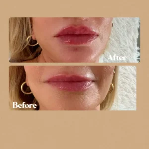 Lip filler before/after by Lips Boutique By JKA in Toronto, ON