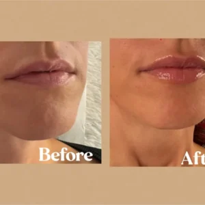 Lip filler results by Lips Boutique By JKA in Toronto, ON – before and after
