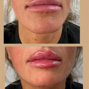 Lip filler before/after by K2 Aesthetics in Toronto, ON
