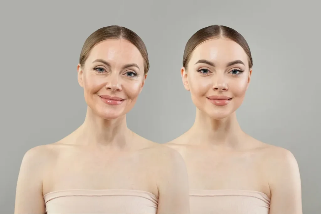 Before and after results of Radiesse® Biostimulators treatment at Lips Boutique® and Beauty Lab in Toronto, ON