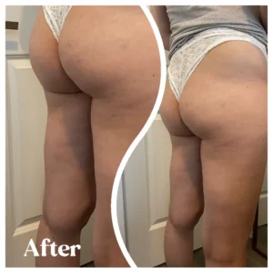 Before and after results of Buttock enhancement treatment at Lips Boutique® and Beauty Lab in Toronto, ON