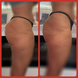 Before and after results of Buttock enhancement treatment at Lips Boutique® and Beauty Lab in Toronto, ON