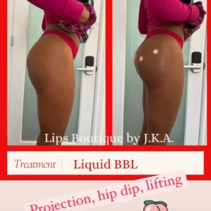 Before and after results of Liquid BBL treatment at Lips Boutique® and Beauty Lab in Toronto, ON