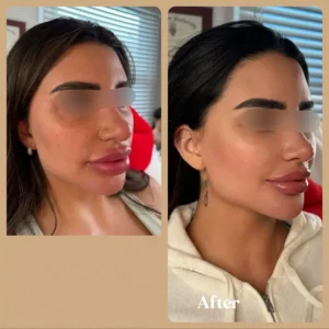Before and After Photos on Face Rejuvenation | Lips Boutique & Beauty Lab in Toronto, ON