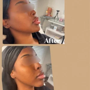 Before and After Photos on Face Rejuvenation Treatment | Lips Boutique & Beauty Lab in Toronto, ON