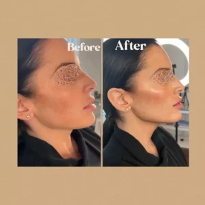 Before and After Photos on Face Rejuvenation | Lips Boutique & Beauty Lab in Toronto, ON