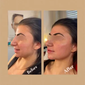 Before and After Photos on Face Rejuvenation | Lips Boutique & Beauty Lab in Toronto, ON