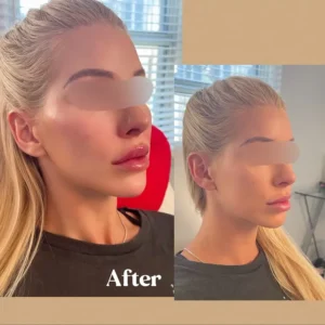 Before and After Photos on Skin Tightening Treatment | Lips Boutique & Beauty Lab in Toronto, ON