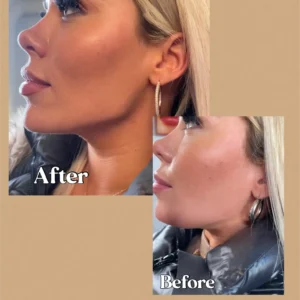 Before and After Photos on Skin Rejuvenation | Lips Boutique & Beauty Lab in Toronto, ON