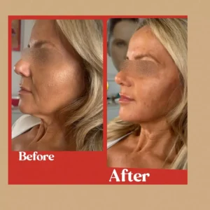 Before and After Photos on Face Rejuvenation Treatment | Lips Boutique & Beauty Lab in Toronto, ON