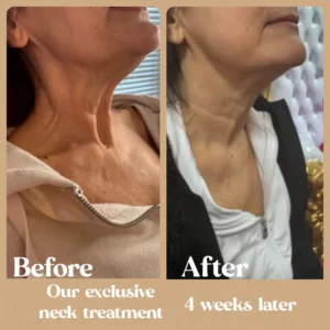 Before and After Photos on Neck Treatment | Lips Boutique & Beauty Lab in Toronto, ON