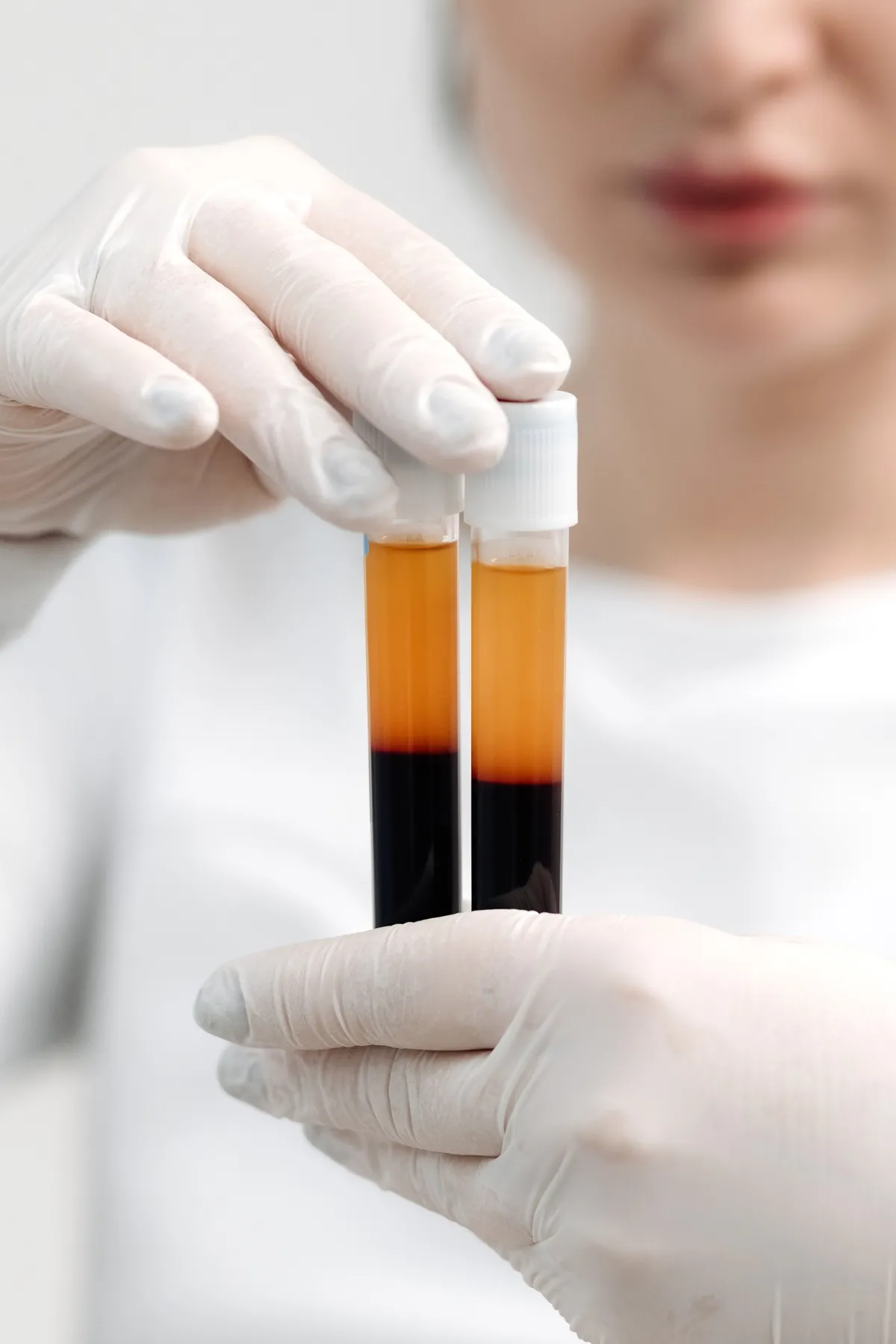 A female holding PRP test tubes with separated plasma and blood for cosmetic treatment at Lips Boutique® and Beauty Lab in Toronto, ON