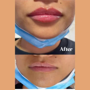 Before and After Photos on Lip Filler Treatment | Lips Boutique & Beauty Lab in Toronto, ON