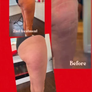 lipo before and after by Lips Boutique by JKA Inc in Toronto, On