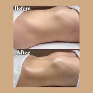 lipo before and after by Lips Boutique by JKA Inc in Toronto, On