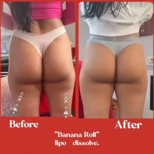 lipo before and after by Lips Boutique by JKA Inc in Toronto, On