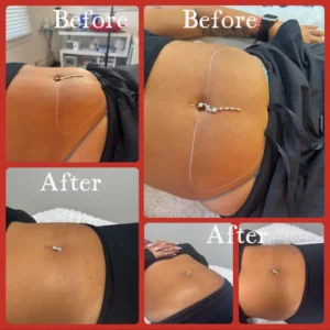 lipo before and after by Lips Boutique by JKA Inc in Toronto, On