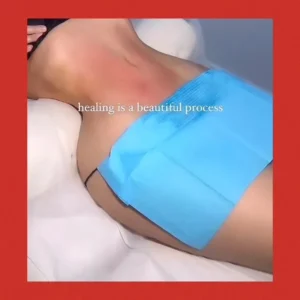 lipo before and after by Lips Boutique by JKA Inc in Toronto, On