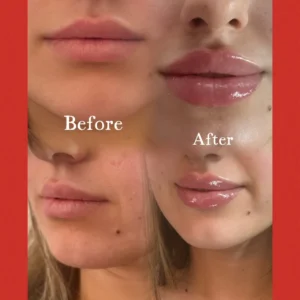 lips aa Treatment by Lips Boutique by JKA Inc in Toronto, On
