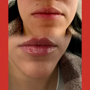 lips bb Treatment by Lips Boutique by JKA Inc in Toronto, On