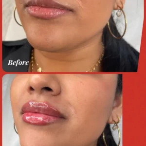 lips Treatment by Lips Boutique by JKA Inc in Toronto, On
