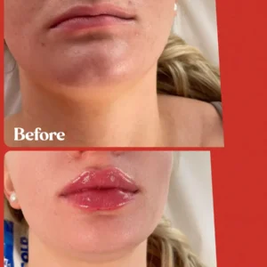 lips Treatment by Lips Boutique by JKA Inc in Toronto, On
