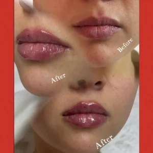 lips Treatment by Lips Boutique by JKA Inc in Toronto, On