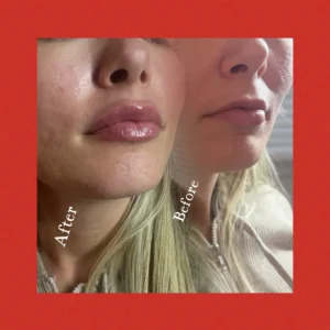 lips before and after by Lips Boutique by JKA Inc in Toronto, On