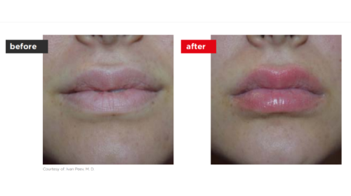 Fontona4d-6d-Before_after (4)-a--