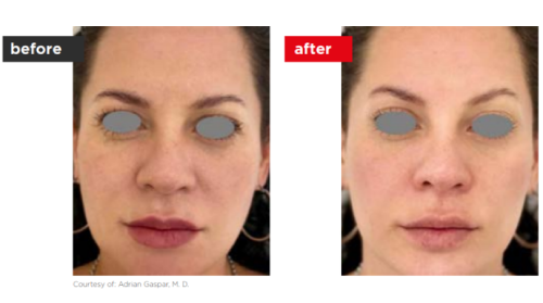 Fontona4d-6d-Before_after (6)-a--