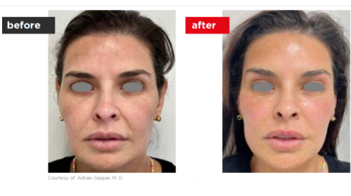 Fontona4d-6d-Before_after (7)-a--