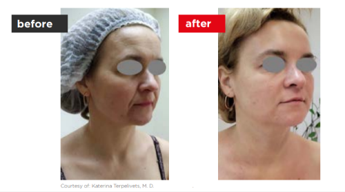 Fontona4d-6d-Before_after-a--